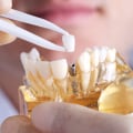 What don't they tell you about dental implants?