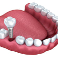 How long does it take for the implant to stop hurting?