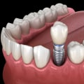 When will i feel better after dental implants?