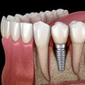 What is the most common cause of dental implant failure?