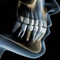What is the downfall of dental implants?