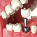 How can i speed up healing after dental implants?