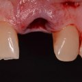 What is the 3/2 rule for dental implants?