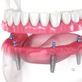 Other Factors to Consider When Getting Full Mouth Dental Implants