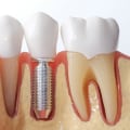 Who shouldn't get a dental implant?