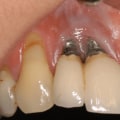 Can a dental implant cause problems years later?