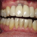 When are dental implants not a good idea?