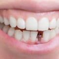 At what stage do dental implants fail?