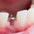 What are the chances of the implant failing?