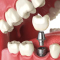 Is it worth it to get a dental implant?
