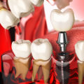 What is the best painkiller for dental implants?