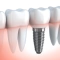 How long is the pain after a dental implant?