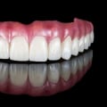 How often does the body reject a dental implant?