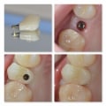 What is the first step in the dental implant process?