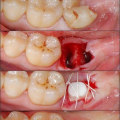How long does it take for a dental implant to stop hurting?