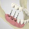 Steps Involved in Full Mouth Implant Placement