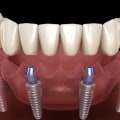 Requirements for Full Mouth Implants: A Comprehensive Guide