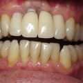 Why not to get dental implants?