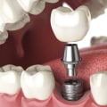 Is dental implant more painful than extraction?