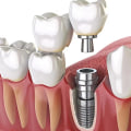 Understanding Follow-Up Care for Dental Implants