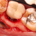 What are the bad experiences with dental implants?