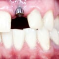 What is the most common site for implant failure?
