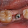 Understanding the Recovery Process and Timeline for Dental Implants