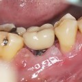 What is the downside of having teeth implants?