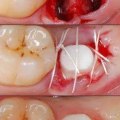 What is the pain level of a dental implant?