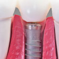 What percent of dental implants are rejected?