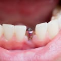 How long does it take to put in the screw for a dental implant?