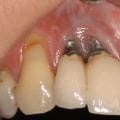 What is the negative to getting dental implants?