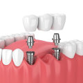 What are the 3 types of dental implants?