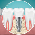 Which oral site has the highest implant failure rate?