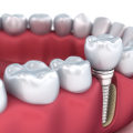 Are implants more painful than root canals?