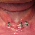 How can you tell if a dental implant is going bad?