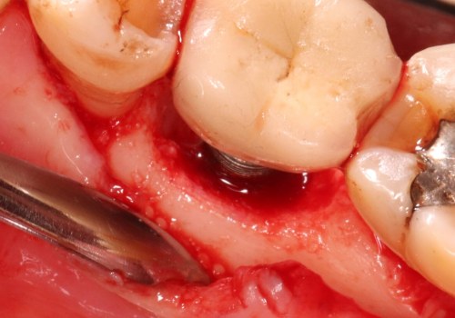 Can a dental implant become infected years later?