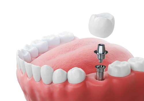 Assessing Bone Density and Gum Health: A Comprehensive Guide to Understanding Dental Implants