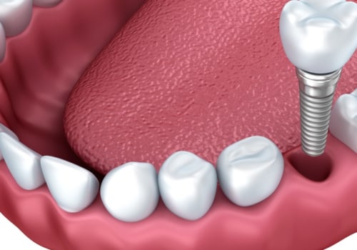 How do you know if your body is rejecting an implant?