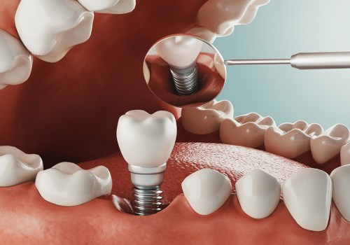 When do implants stop hurting?