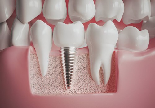 What is the average age to get dental implants?
