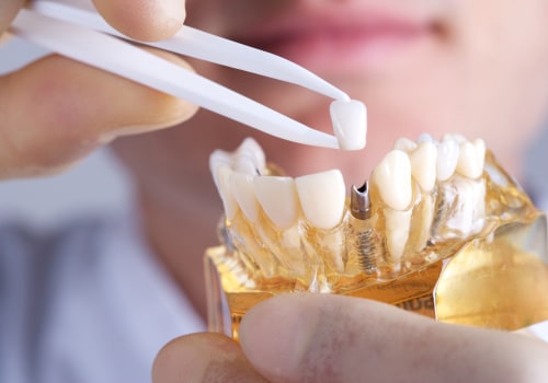 What don't they tell you about dental implants?