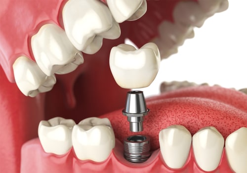 Are dental implants worth it?