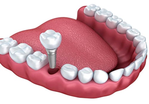 How long does it take for the implant to stop hurting?