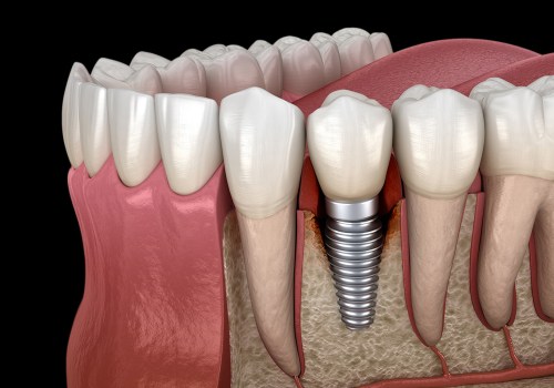 What is the most common cause of dental implant failure?