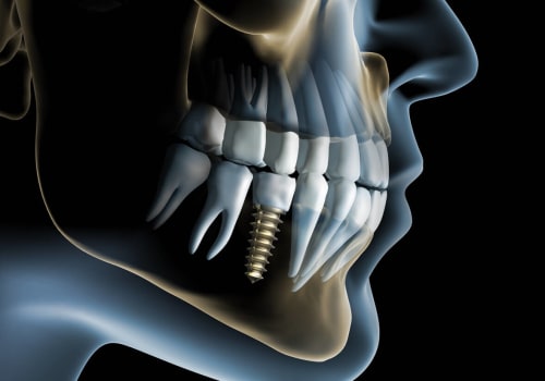 What is the downfall of dental implants?