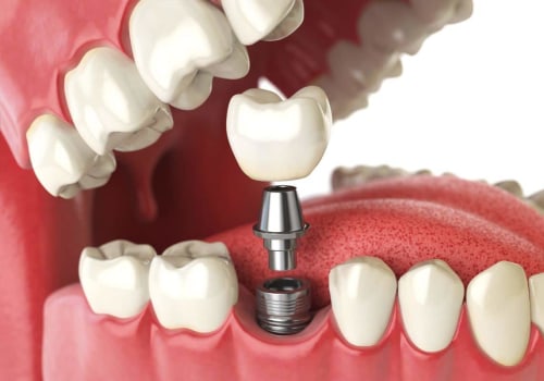 How can i speed up healing after dental implants?