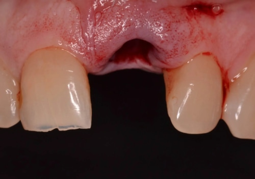 What is the 3/2 rule for dental implants?