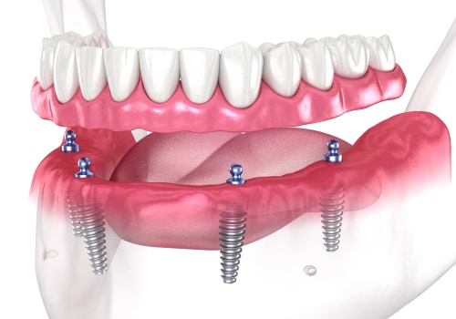 Other Factors to Consider When Getting Full Mouth Dental Implants