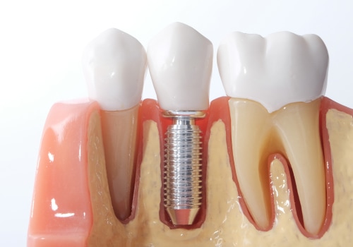 Who shouldn't get a dental implant?